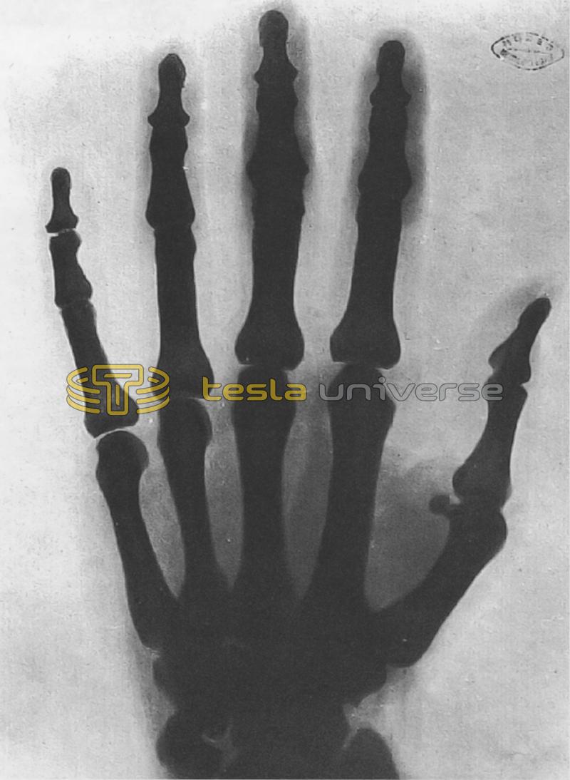 One of the earliest x-ray photographs, this one of Tesla's hand
