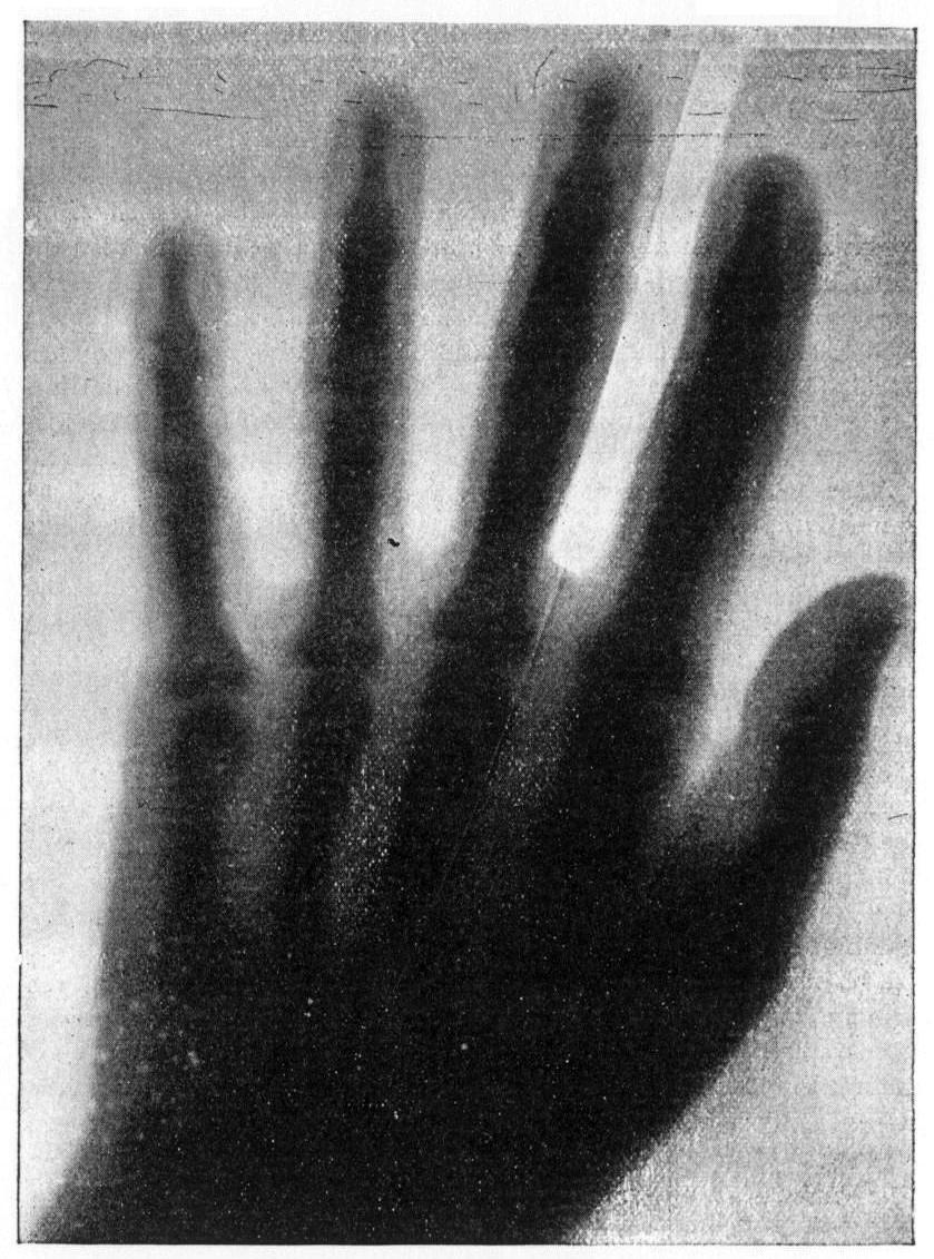 X-ray image of a hand taken by Prof. Pupin