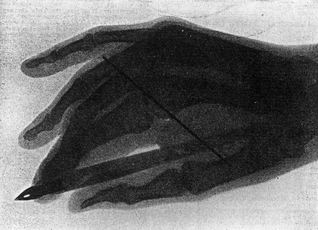 X-ray radiograph image of a human hand