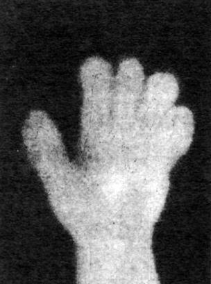 Electrical autograph of the human hand charged with high voltage