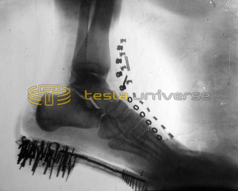 One of the earliest X-ray photos, this one of Tesla's foot