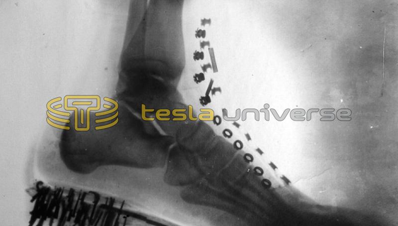 One of the earliest X-ray photos, this one of Tesla's foot