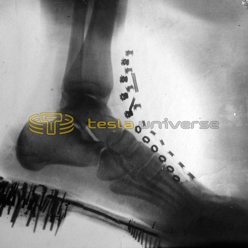 One of the earliest X-ray photos, this one of Tesla's foot