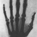 One of the earliest x-ray photographs, this one of Tesla's hand
